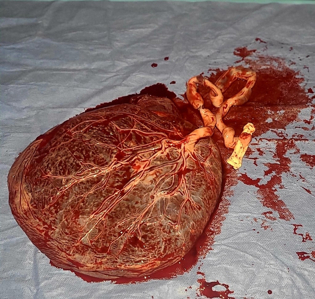 A close-up of a human placenta with visible blood vessels, lying on a surgical drape.